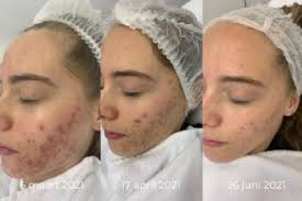 acne gezichtsbehandeling