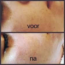 huidverbeterende peeling