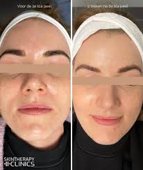 peeling gezicht