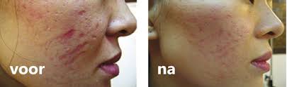 gezichtsbehandeling dermapen