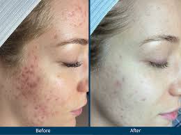 microneedling