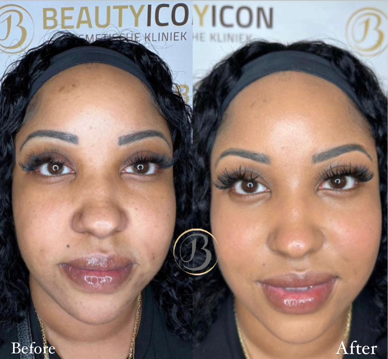 kosten gezichtsbehandeling