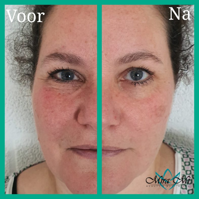 last minute gezichtsbehandeling