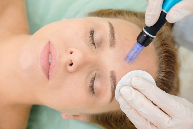microneedling schoonheidsspecialist