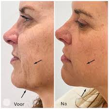 huid verbeteren gezicht