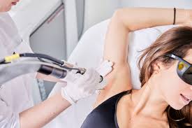 permanent laser ontharen