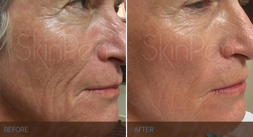 dermapen gezichtsbehandeling
