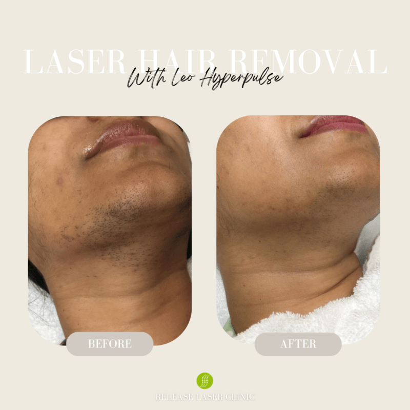 gezicht ontharen laser