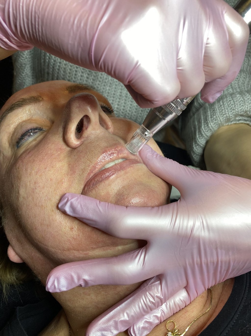gezichtsbehandeling microneedling