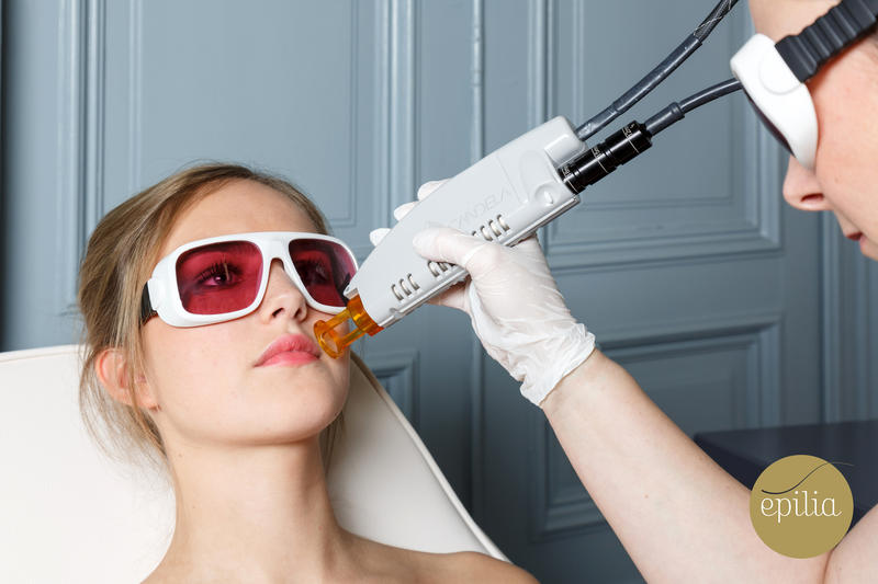laser ontharen gezicht